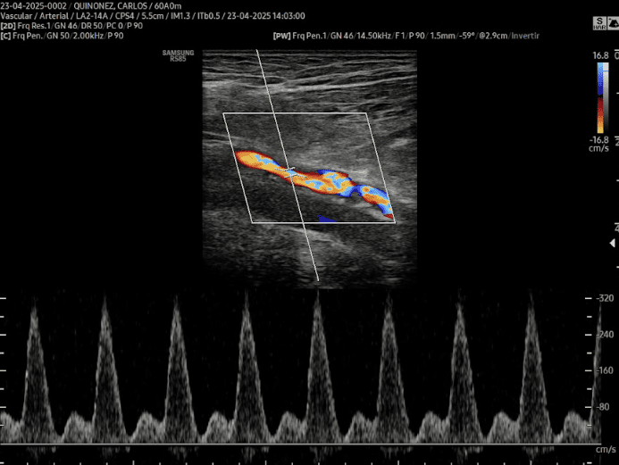 DOPPLER DE VENOSO - ARTERIAL