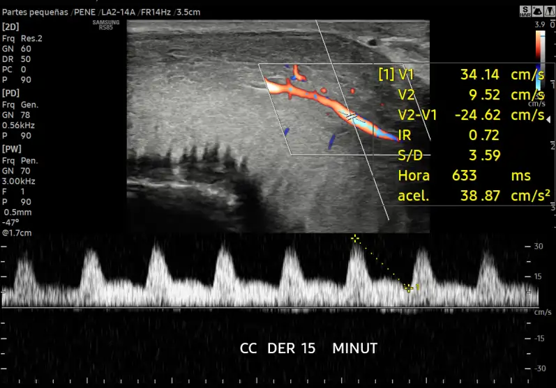DOPPLER DE PENE CON SUSTANCIA VASOACTIVA