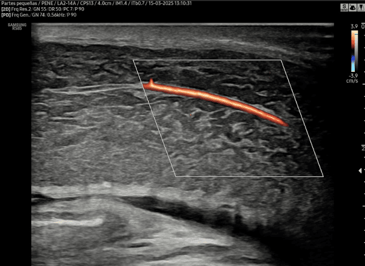 DOPPLER DE PENE CON SUSTANCIA